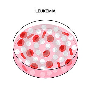 Leukemia cancer disease photo