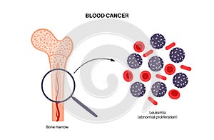 Leukemia cancer disease photo