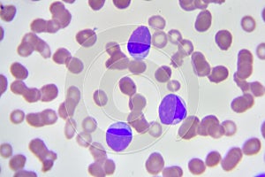 Leukemia cells