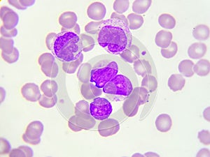 Leukemia cells