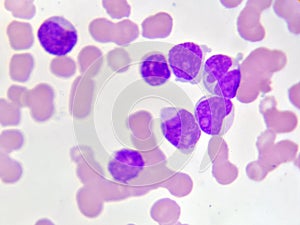 Leukemia cells