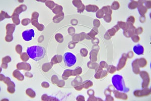 Leukemia cells