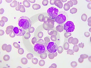 Leukemia cells