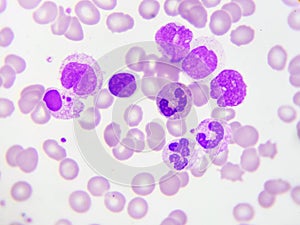 Leukemia cells in blood smear