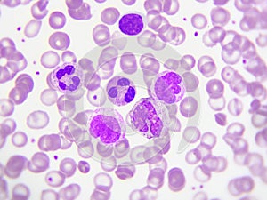 Leukemia cells in blood smear