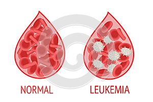 Leukemia. Comparison of a drop of blood with normal and leukemic blood cells photo