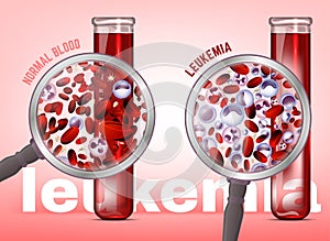 Leukemia horizontal background photo