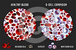 Leucemia imagen 