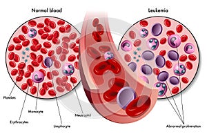 Leukemia