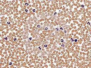 Leukemoid reaction in peripheral blood.