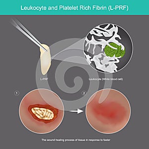 Leukocyte and Platelet Rich Fibrin. Illustration wound healing process of skin tissue by use  Leukocyte from platelet rich fibrin photo