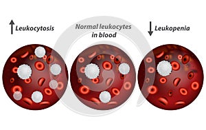 Leukocytosis and Leukopenia. photo