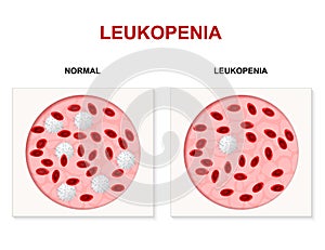 Leukopenia, leukocytopenia or leucopenia