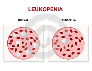 Leukopenia, leukocytopenia or leucopenia photo