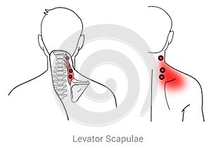 Levator scapulae myofascial trigger point rear upper neck pain