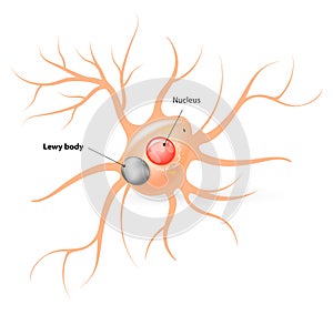 Lewy body. Parkinsons disease and Alzheimers disease photo