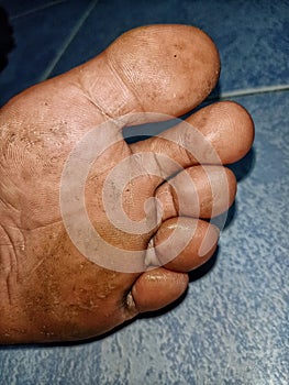 The lid of a person`s foot is broken and is dirty.