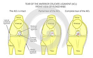 Ligaments of the knee_Tear of the anterior cruciate ligament
