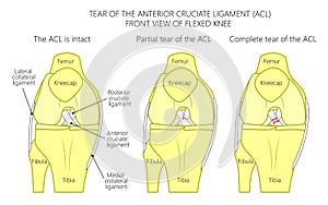 Ligaments of the knee_Tear of the anterior cruciate ligament photo