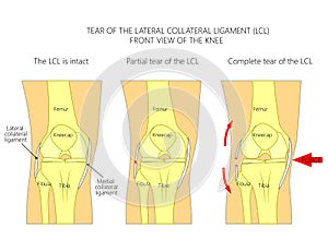 Ligaments of the knee_Tear of the lateral collateral ligament
