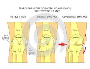 Ligaments of the knee_Tear of the medial collateral ligament