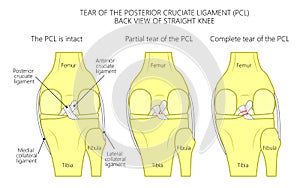 Ligaments of the knee_Tear of the posterior cruciate ligament