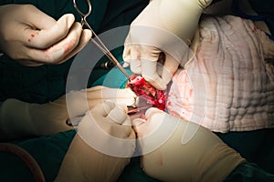 Ligation appendix for appendectomy