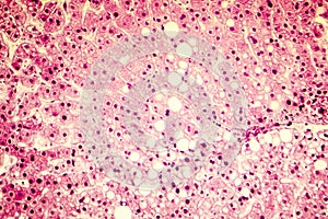 Light micrograph of a fatty liver