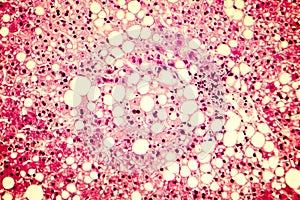 Light micrograph of a fatty liver photo