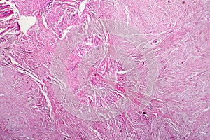Light micrograph of scar tissue photo