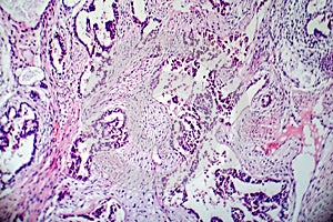 Teratoma, light micrograph photo