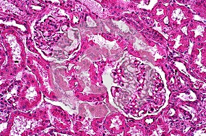 Light microscope Glycogenosis of liver pathology