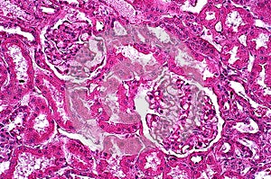 Light microscope Glycogenosis of liver pathology photo
