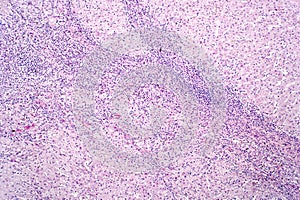 Light microscope liver cirrhosis injury of circulatory organs and blood-forming organs