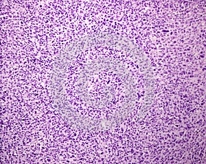 Human skin. Pleomorphic sarcoma