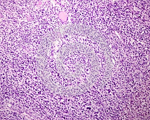 Human skin. Pleomorphic sarcoma