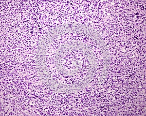 Human skin. Pleomorphic sarcoma