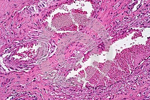 Light microscope of Necrotic oesophagitis pathology