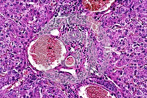 Light microscope of Parenchymatous and fatty degeneration of liver pathology