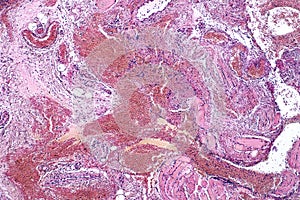 Light microscope Tonsillitis pathology