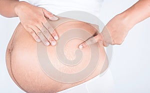 Linea nigra and stretch marks on pregnant women