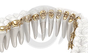 Lingual braces system. 3D illustration concept of golden braces