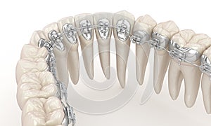 Lingual braces system. 3D illustration concept of silver braces