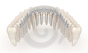Lingual braces system. 3D illustration concept of silver braces