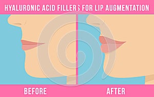 Lip augmentation effects