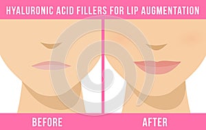 Lip augmentation effects