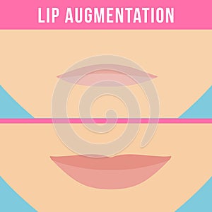 Lip augmentation effects