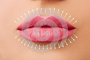 Lip augmentation. Fillers. Beautiful perfect pink lips