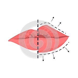 Lip augmentation illustration in color cartoon style. Editable vector graphic design.