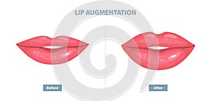 Lip Augmentation. Before and after lip filler injections. Vector